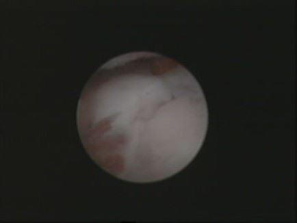 loses abgebrochenes Knochenstück im Ellbogengelenk