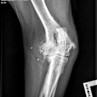 Cubarthrose mit Goldimplantat